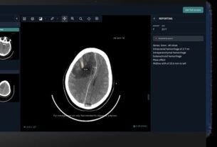 NHS Greater Glasgow and Clyde first to roll out head-CT AI solution