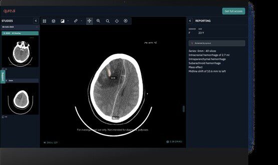 NHS Greater Glasgow and Clyde first to roll out head-CT AI solution