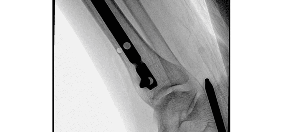 Philips Receives FDA 510(k) Clearance on Image-Guided Surgical Therapy