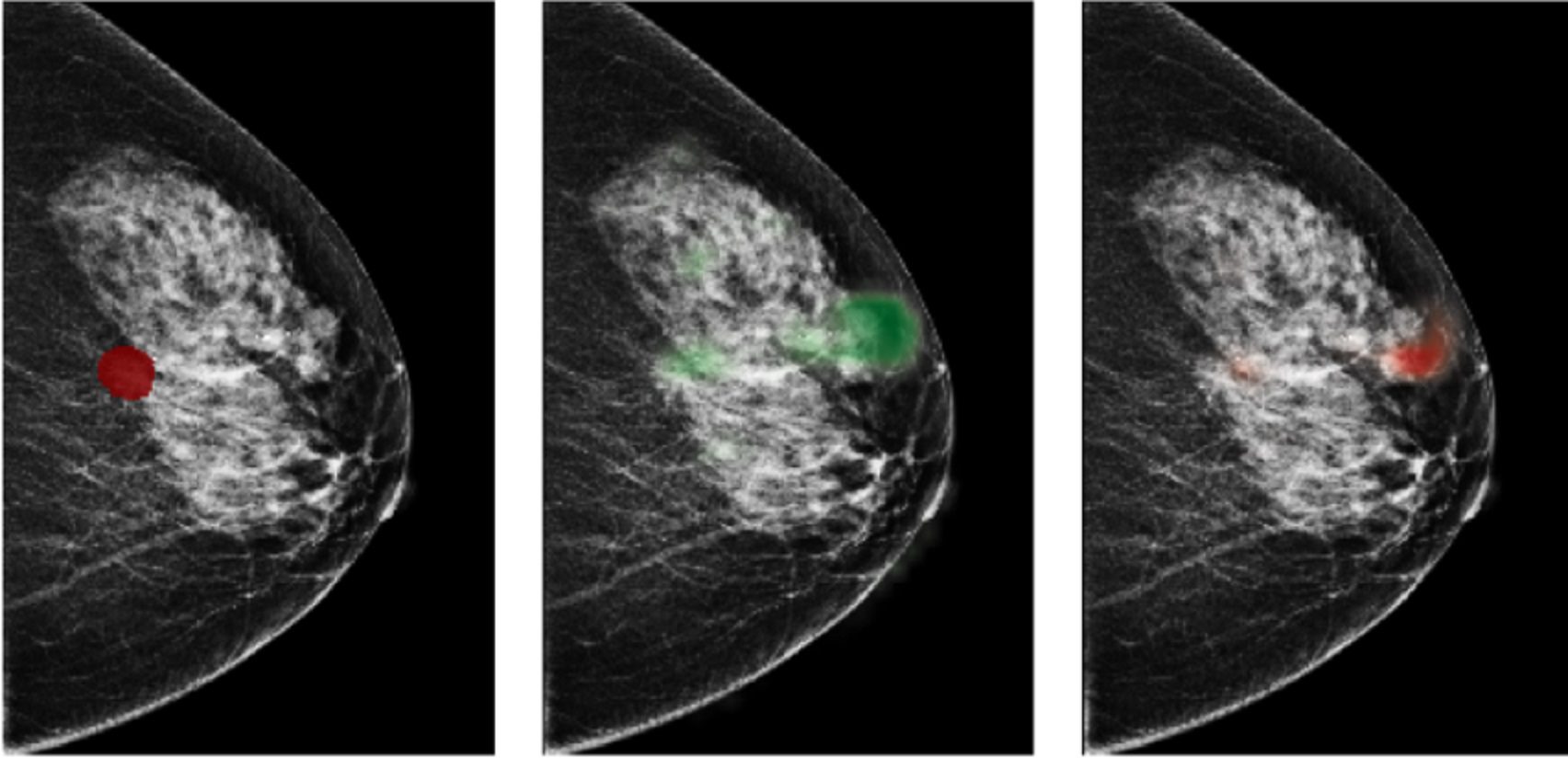 Utilizing Deep Learning to Mitigate False Positives in Screening Mammography