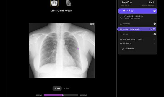 AI chest X-ray tool made available to radiologists at over 40 NHS trusts