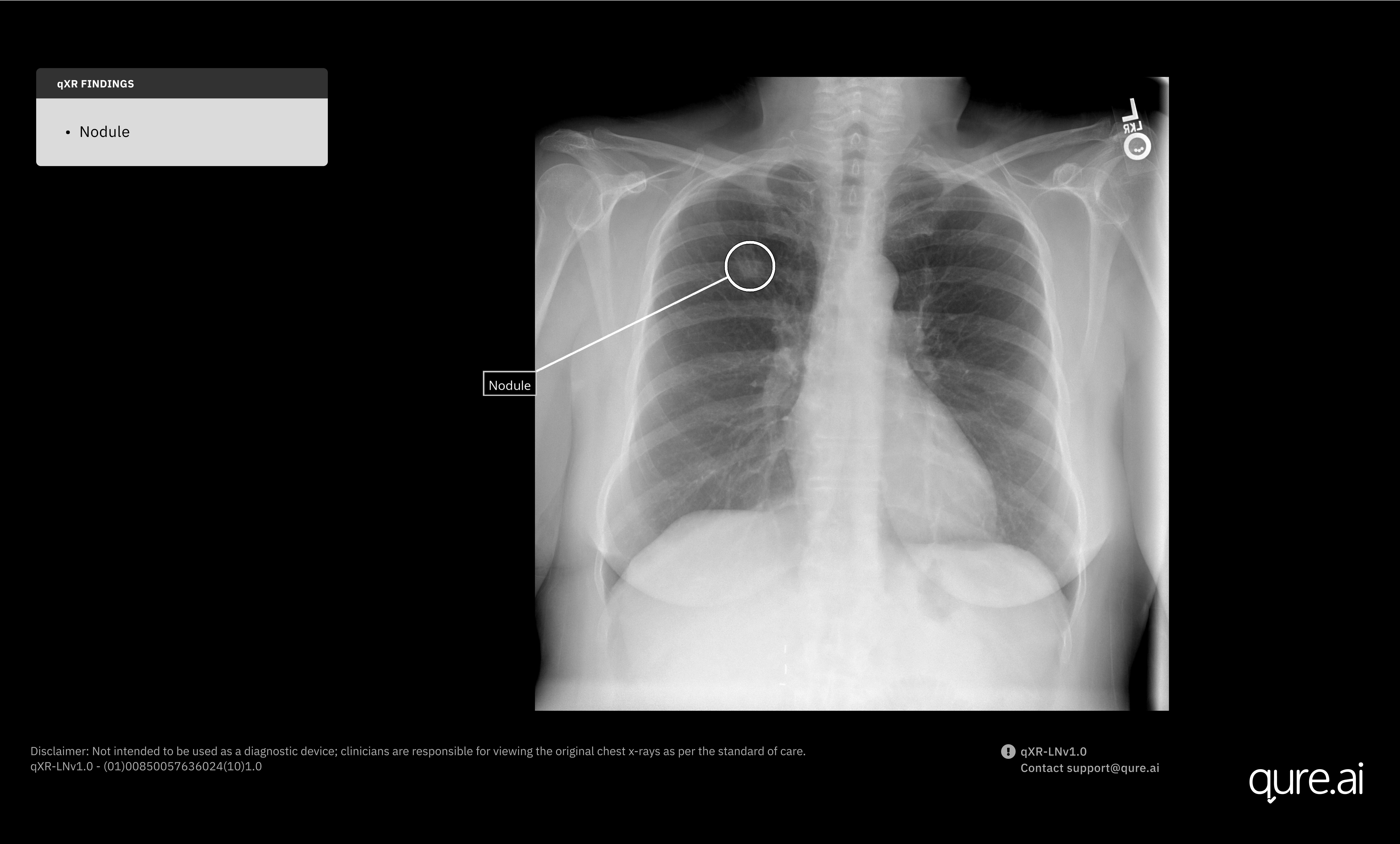 Merck Global Health Innovation Fund Invests in Qure.ai to Expand Lung Cancer Detection