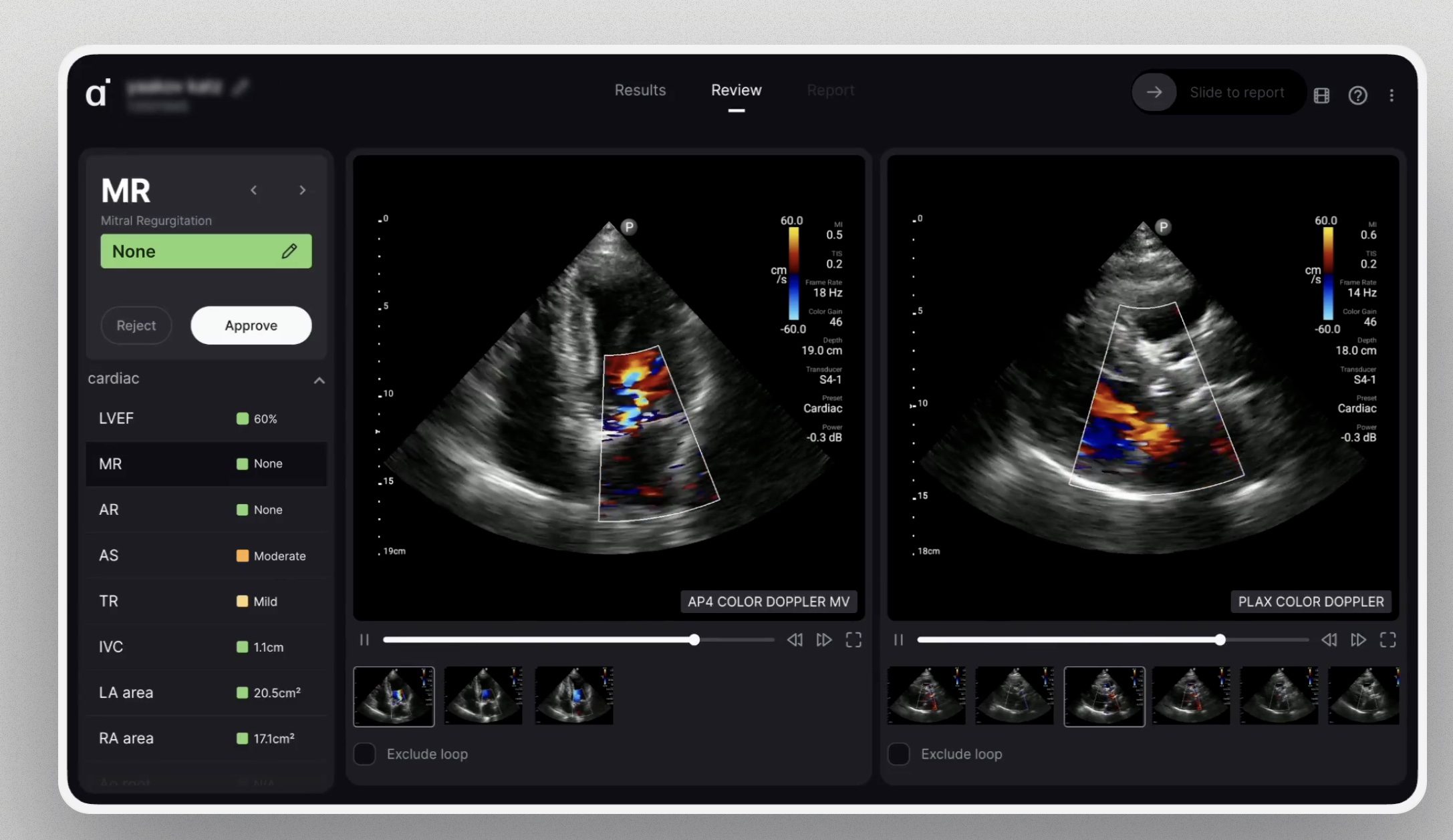 AISAP's AI-Powered Cardiac Ultrasound Receives FDA Clearance
