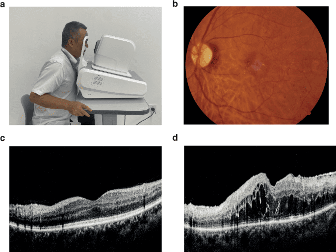Cost-effectiveness of incorporating self-imaging optical coherence tomography into fundus photography-based diabetic retinopathy screening