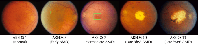 Harnessing the power of longitudinal medical imaging for eye disease prognosis using Transformer-based sequence modeling