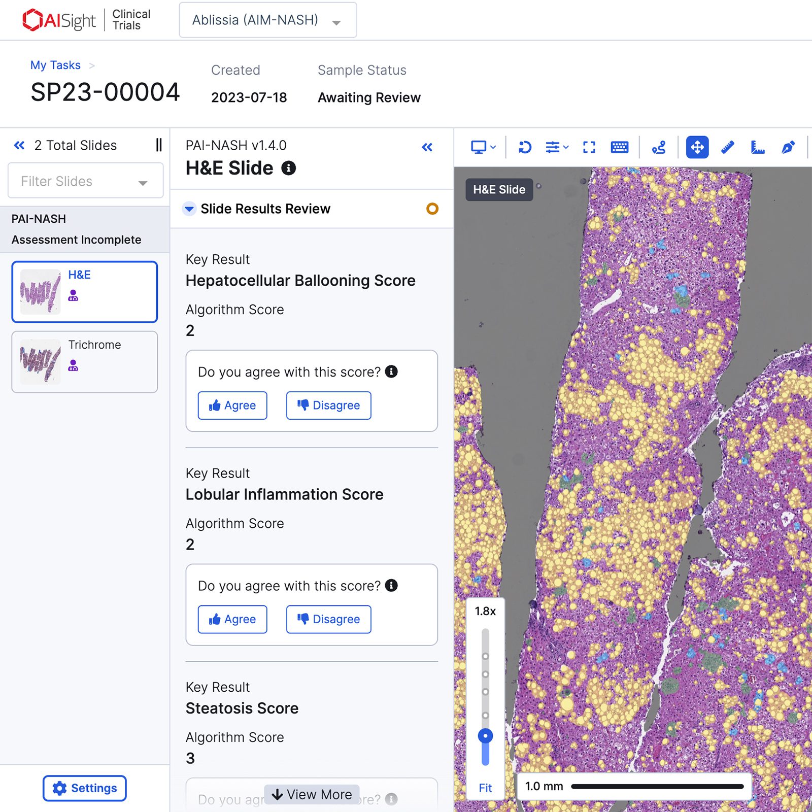 PathAI Introduces AI-Based Measurement for MASH Scoring