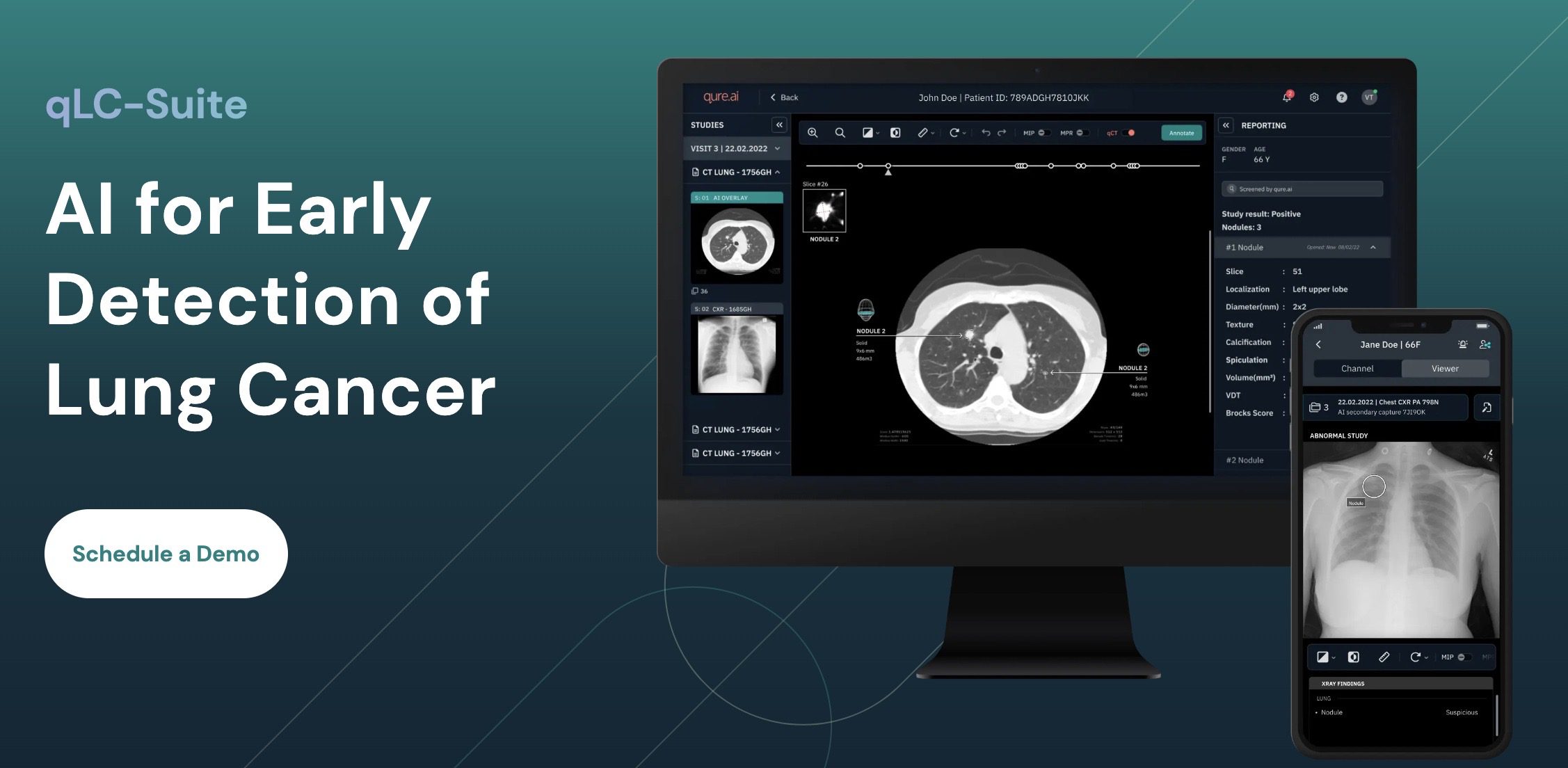 Qure.ai Receives FDA Clearance for AI-Powered Lung Nodule Analysis Tool