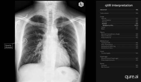 AI Shows Promise in Early Lung Cancer Detection via Chest X-rays