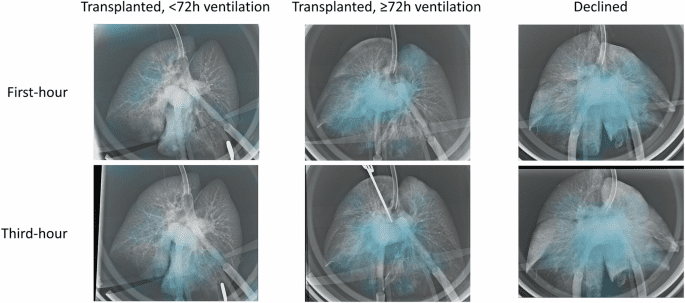 Improving prognostic accuracy in lung transplantation using unique features of isolated human lung radiographs
