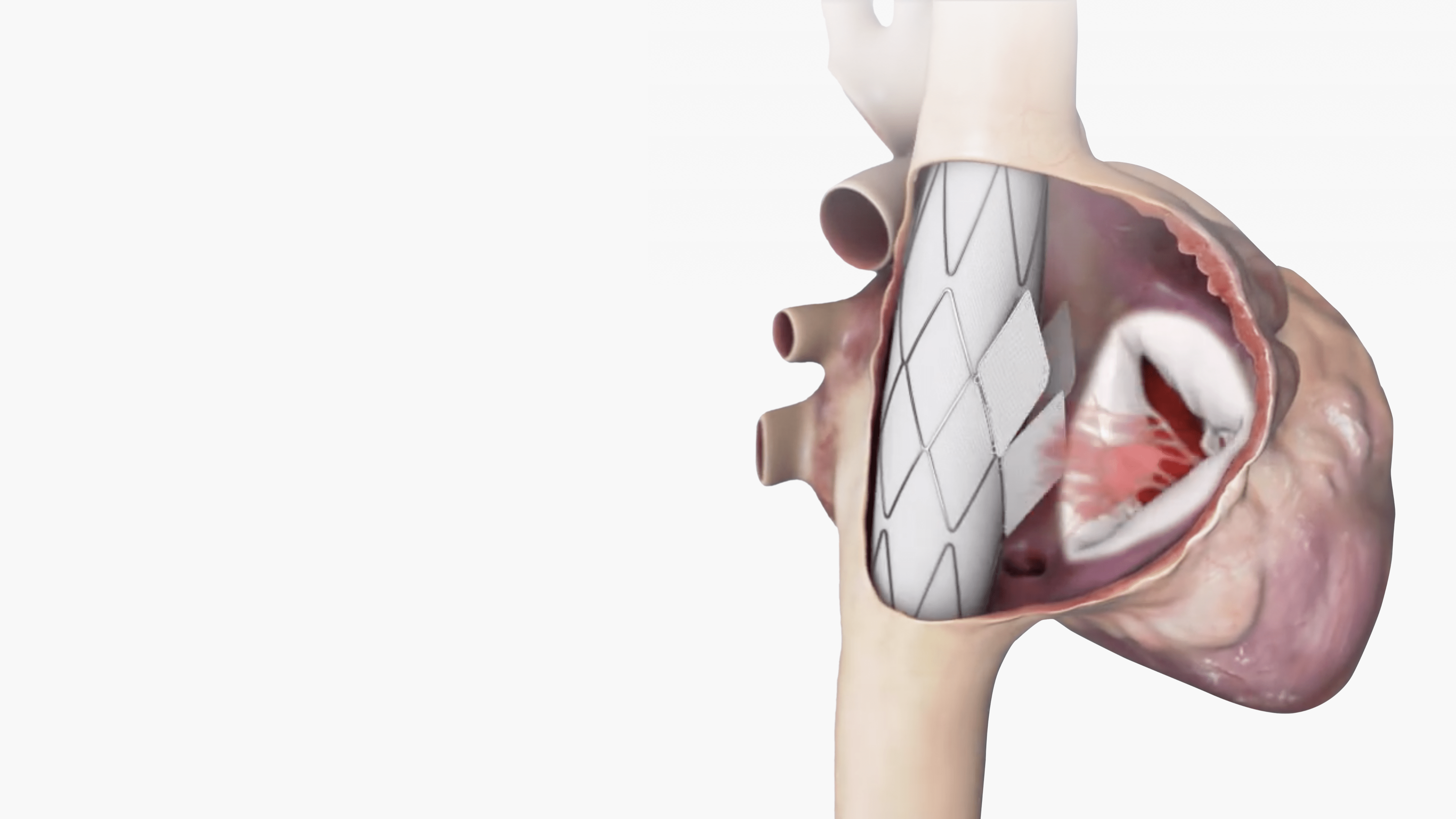 Innoventric Secures $28.5M to Expand Transcatheter Tricuspid Valve Treatment