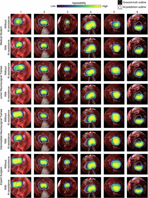 Artificial intelligence assisted operative anatomy recognition in endoscopic pituitary surgery