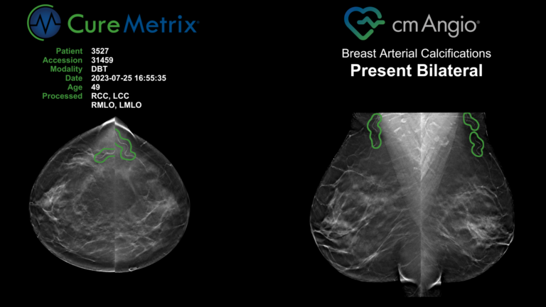 SimonMed Imaging Adopts cmAngio for Early Breast Cancer Detection