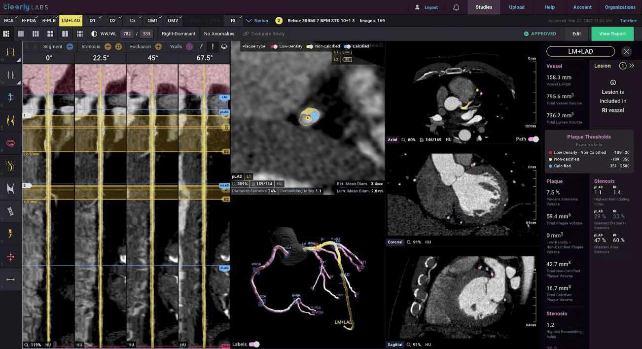 Cleerly Secures $106M to Advance AI-Powered Cardiac Care