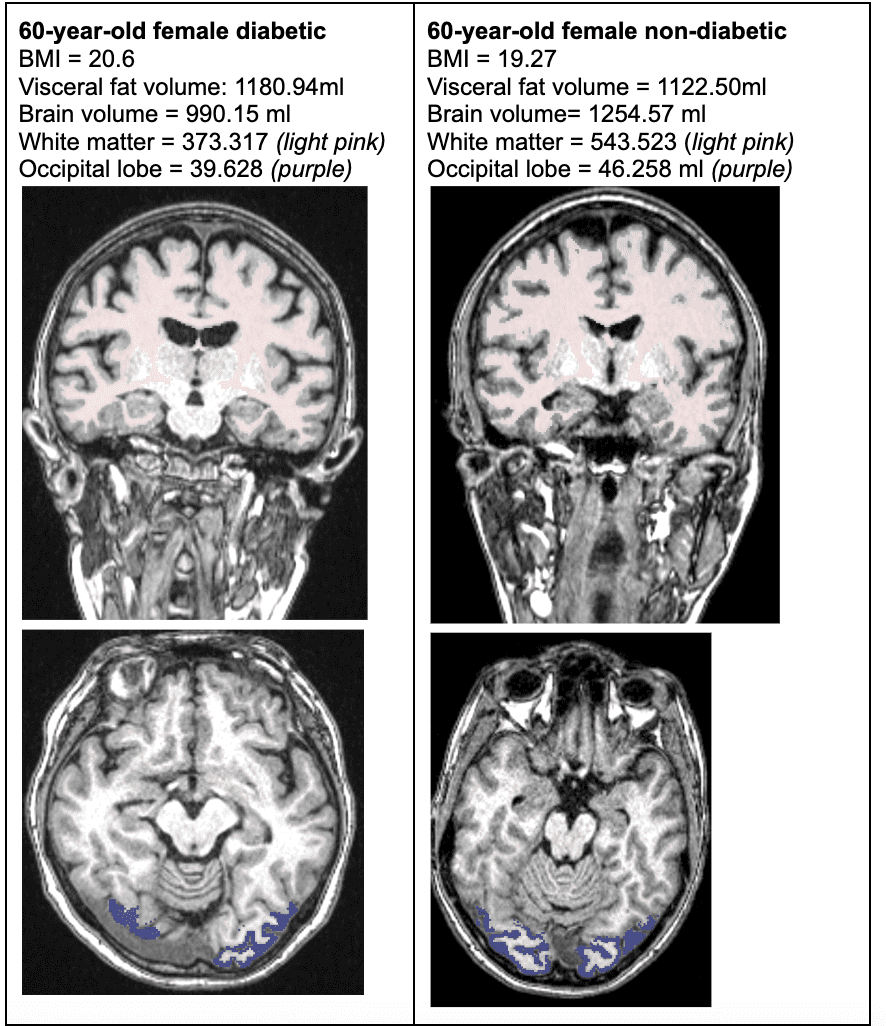 Research Reveals Link Between Type 2 Diabetes and Brain Aging