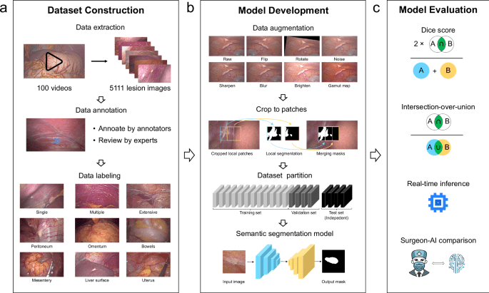 Artificial intelligence assisted real-time recognition of intra-abdominal metastasis during laparoscopic gastric cancer surgery