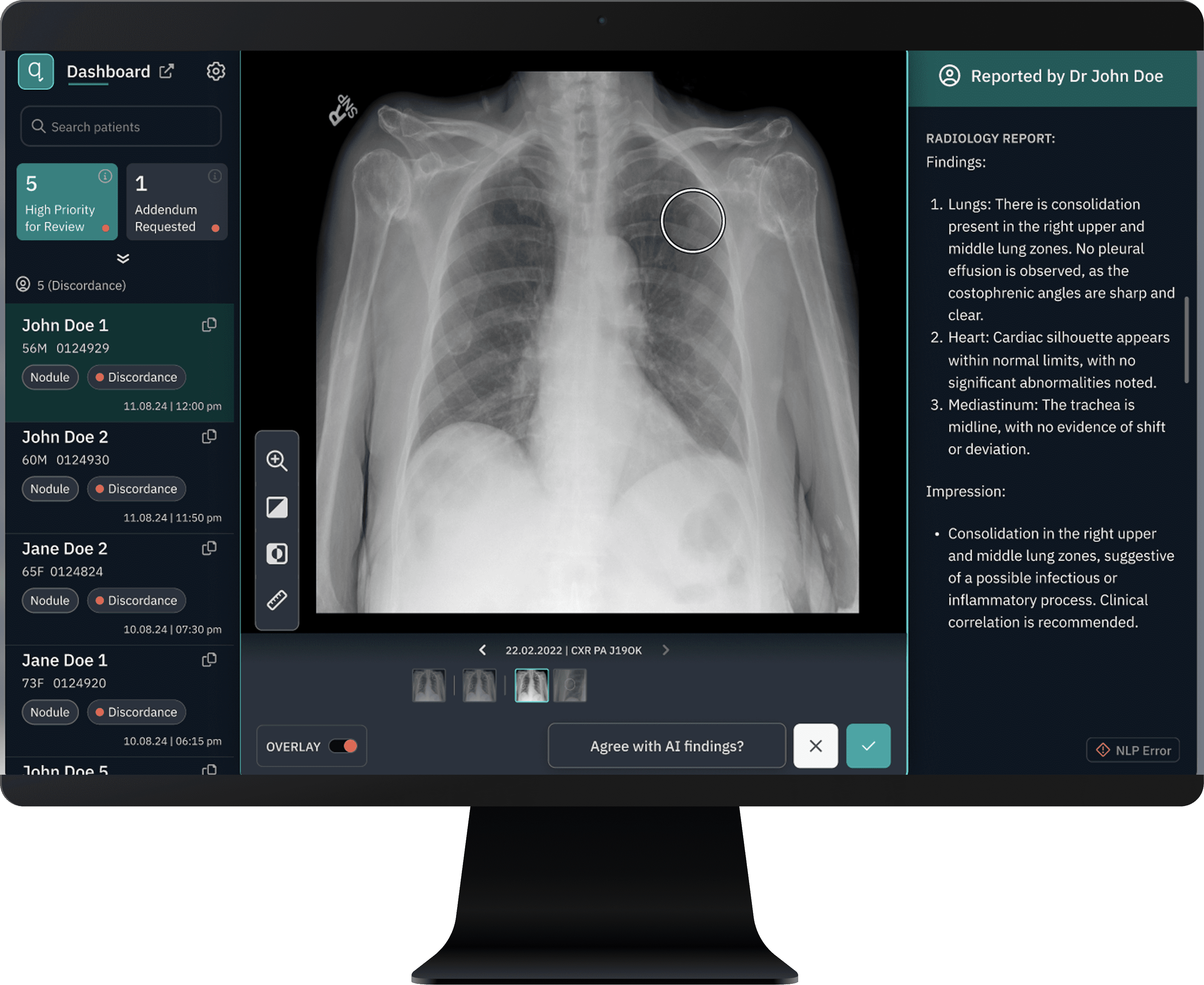 University Hospitals Cleveland Taps AI For Early Lung Cancer Detection
