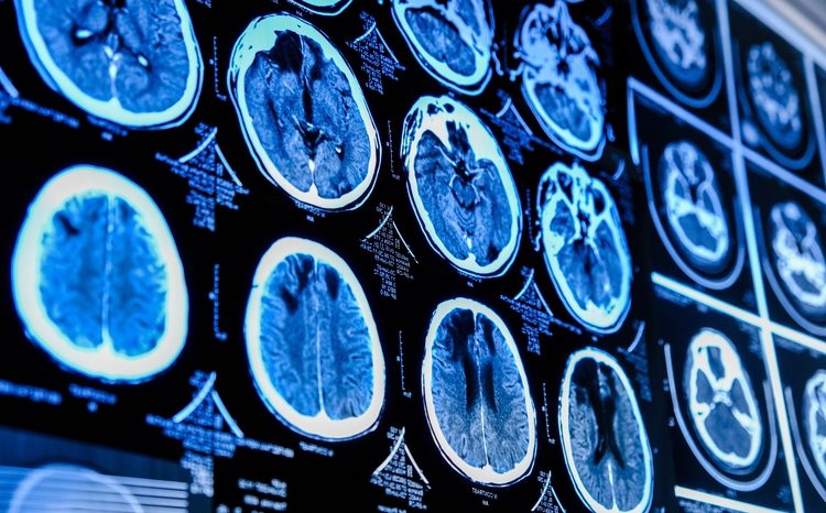 AI project aims to reduce disability caused by strokes
