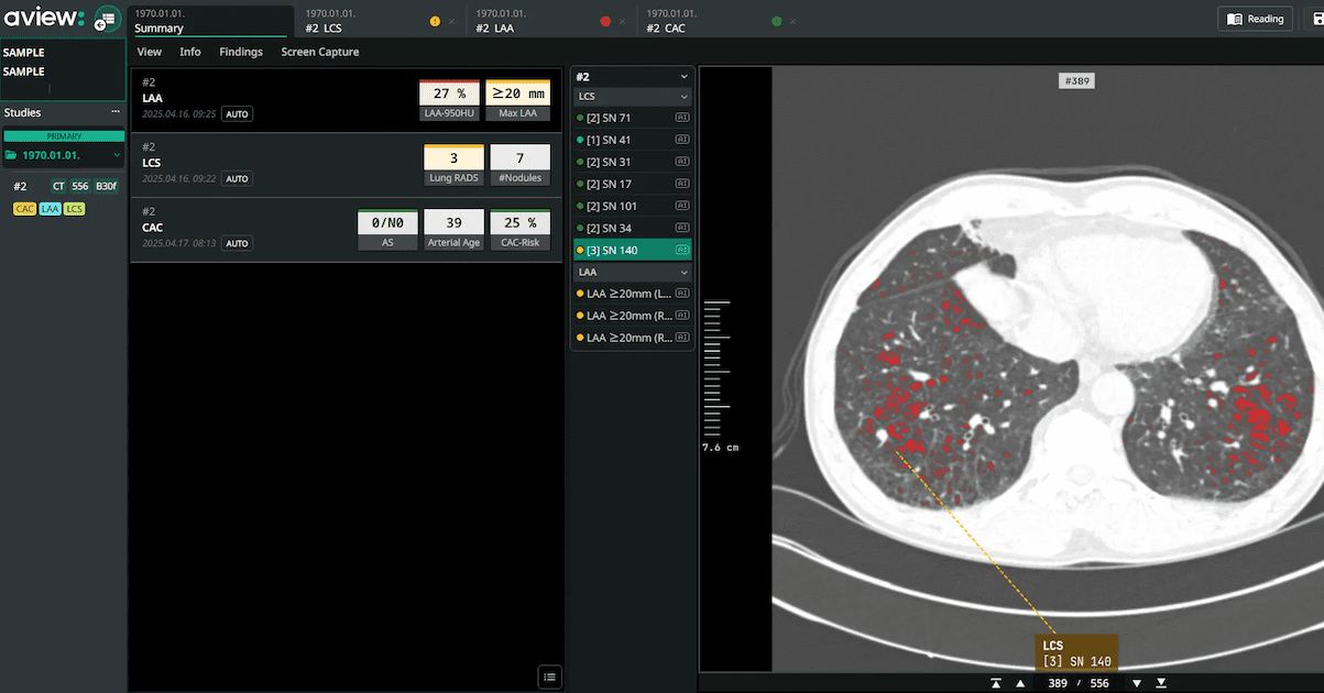 Coreline Soft's lung cancer screening AI added to Bayer's Calantic platform
