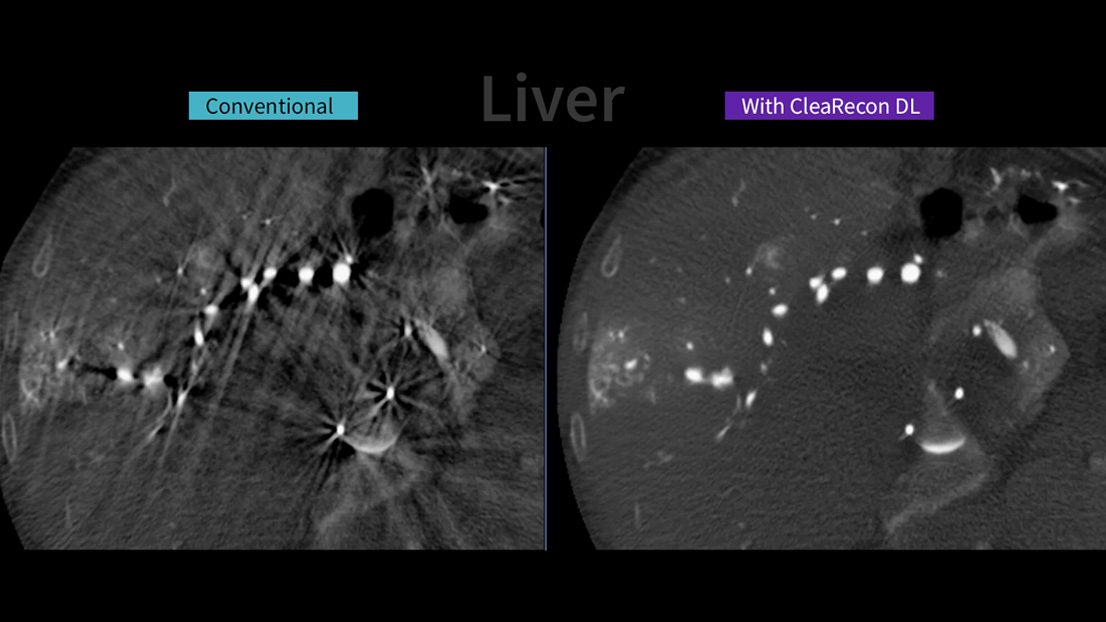GE HealthCare Launches AI-Powered CleaRecon DL to Enhance CBCT Image Quality in Interventional Procedures