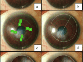 The Nebraska Nomogram for Autograft Planning (NNAP) a surgical planning tool for ipsilateral rotational autokeratoplasty