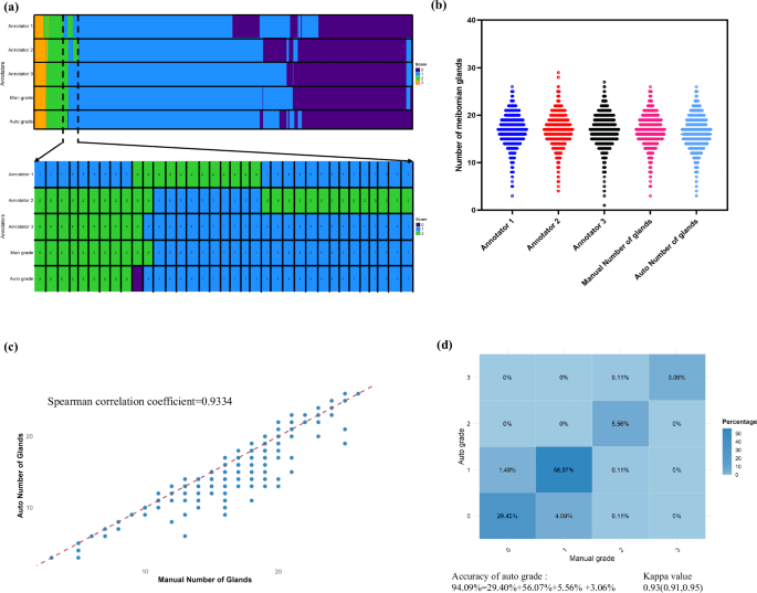 Development and multicenter validation of an AI driven model for quantitative meibomian gland evaluation