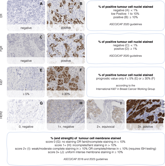 H&E to IHC virtual staining methods in breast cancer: an overview and benchmarking
