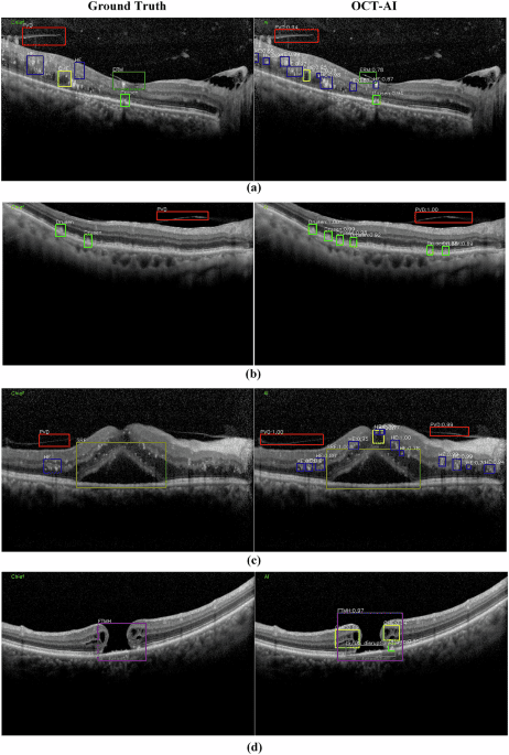 An artificial intelligence cloud platform for OCT-based retinal anomalies screening system in real clinical environments