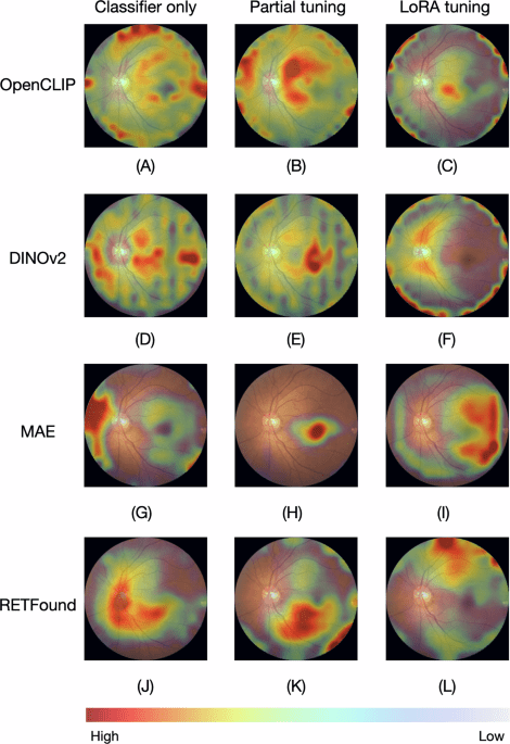 Optimizing retinal images based carotid atherosclerosis prediction with explainable foundation models