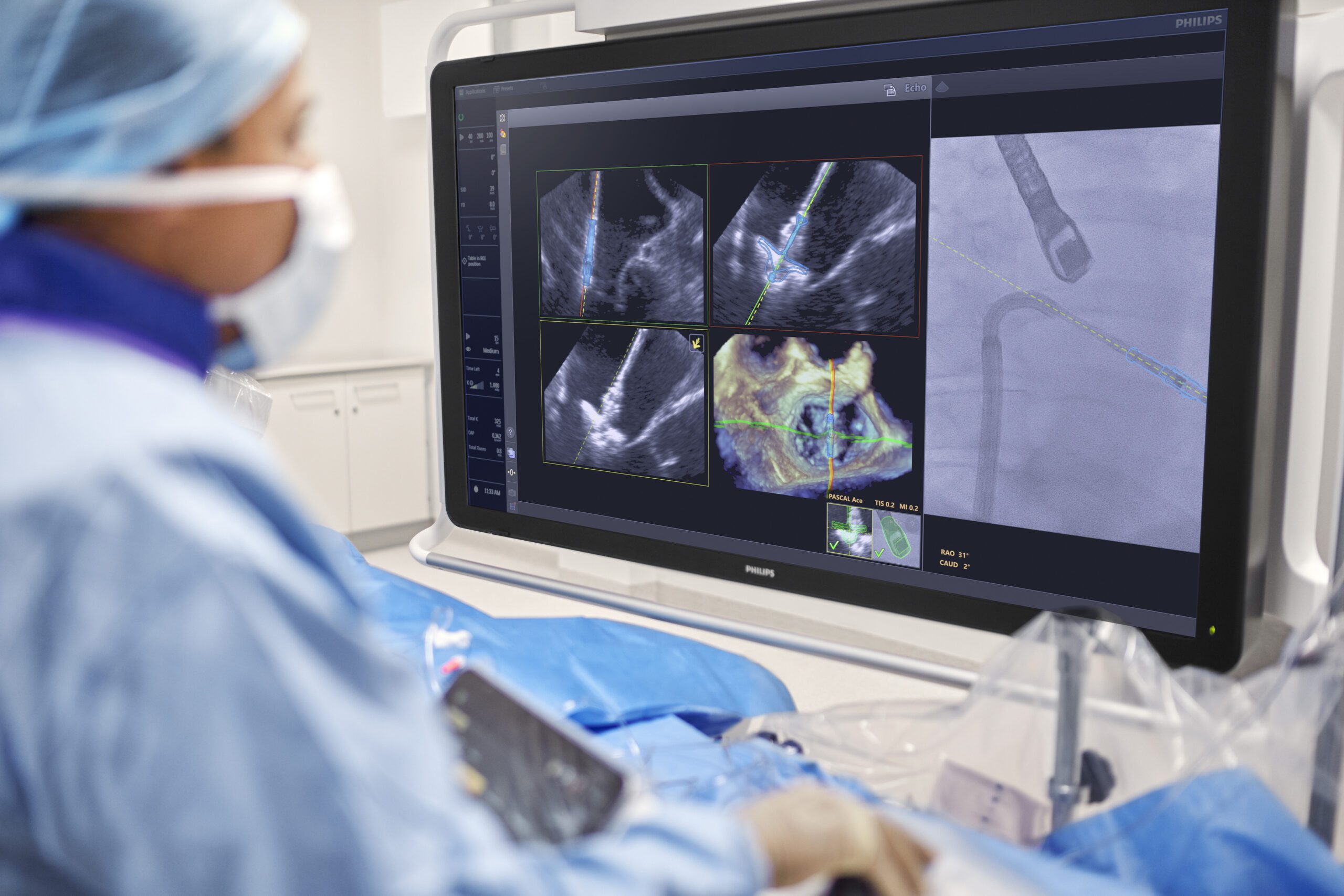 Philips Launches AI-Powered DeviceGuide for Minimally Invasive Valve Repair