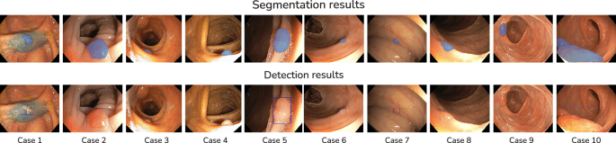 Deep multimodal state-space fusion of endoscopic-radiomic and clinical data for survival prediction in colorectal cancer