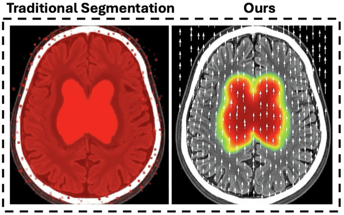 Modeling Ischemic Stroke Pathological Dynamics via Continuous Fields and Vector Flow
