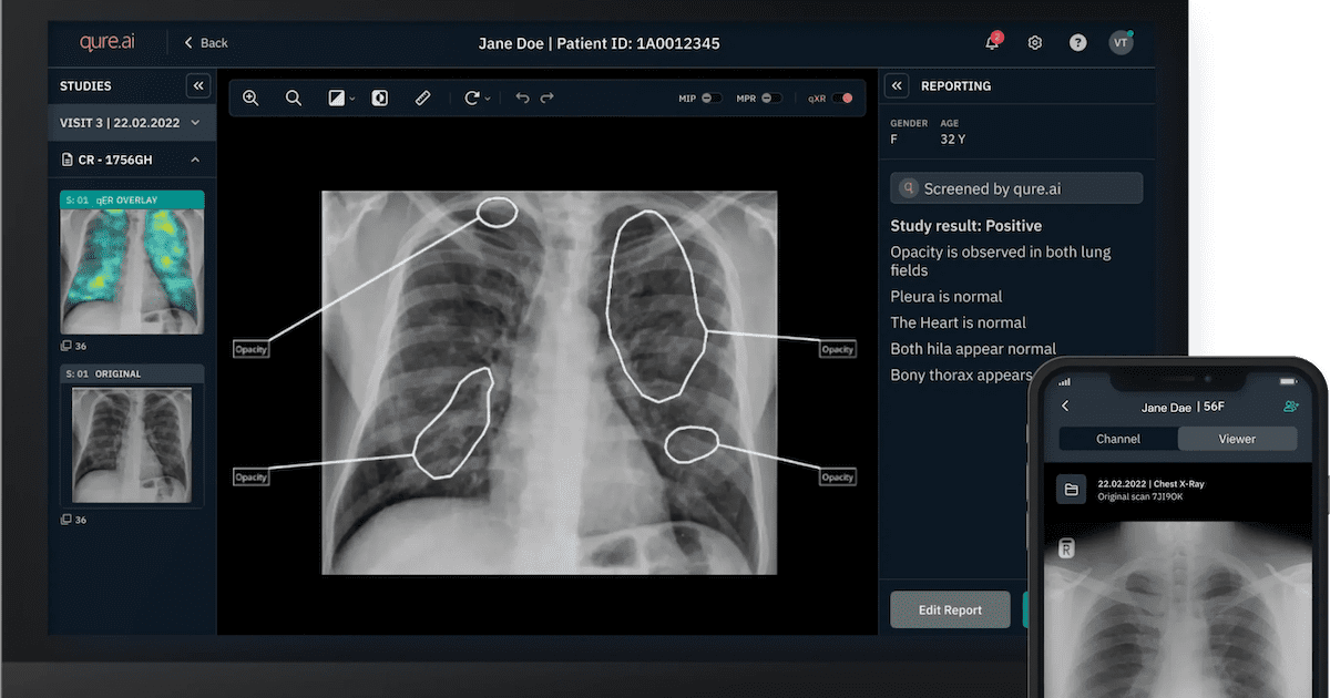 Qure.ai scores multimillion-dollar Gates grant for AI lung ultrasound and more briefs